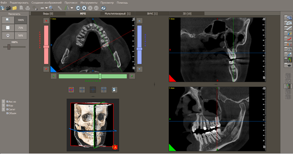 Какие возможности в стоматологии дает компьютерный 3D томограф (КЛКТ) с зонами сканирования FOV 16*16 и 16*18?