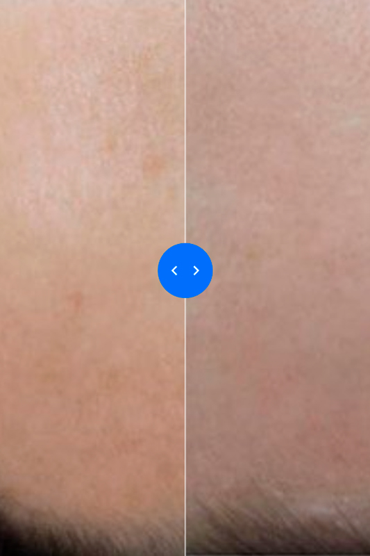 Фракционный лазерный пилинг