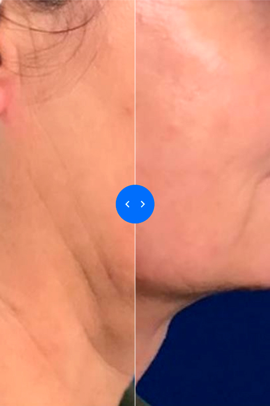 Работа в субментальной зоне