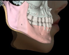 Прогнозирование мягких тканей при совмещении данных 3D реконструкции и 3D-фотографии