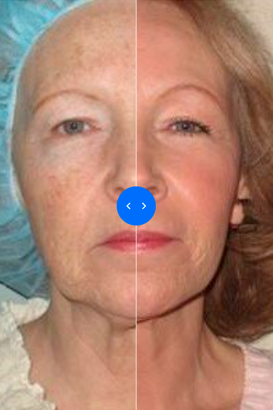 Улучшение качества кожи