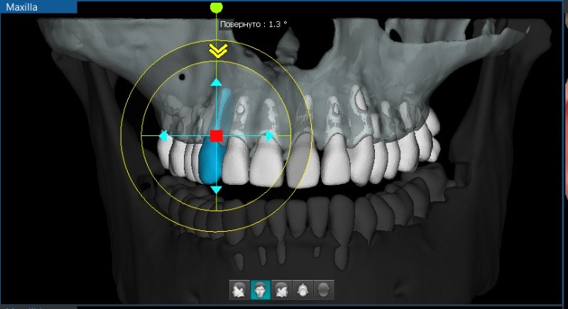 Перемещение отдельных зубов