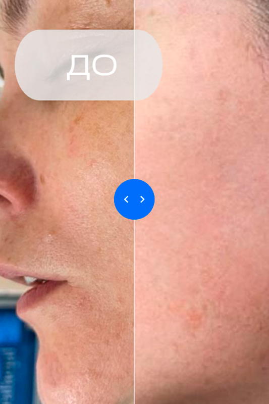 Результат работы с пигментными проявлениями фотостарения кожи