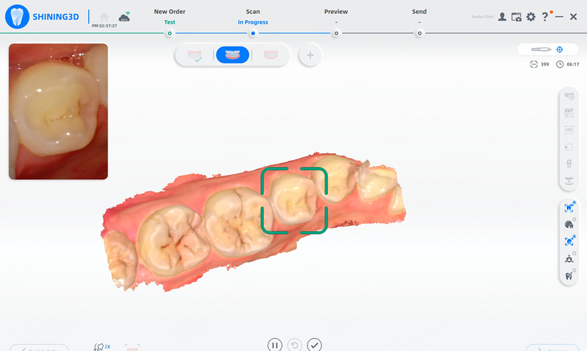 Aoralscan Lync