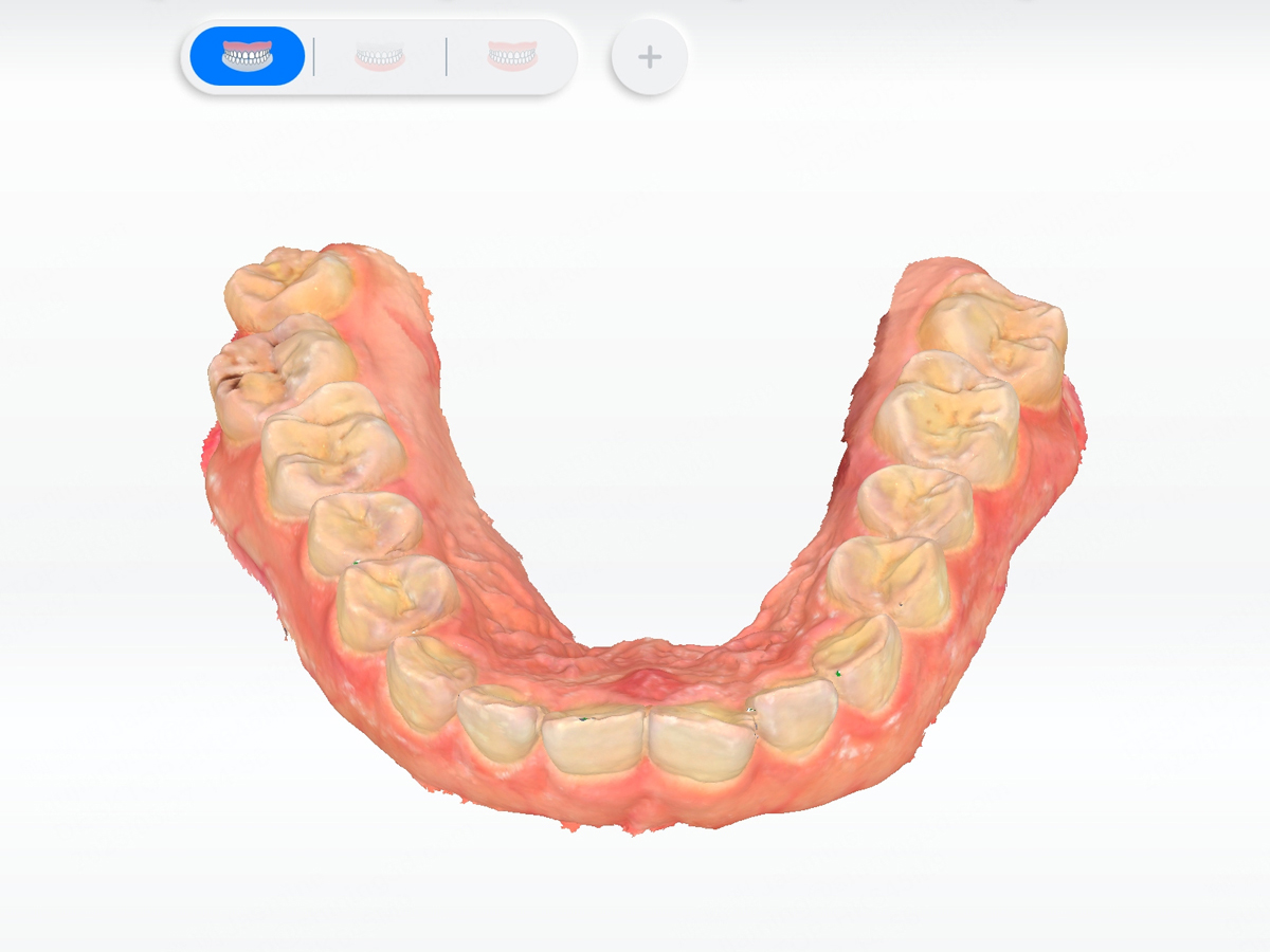 Интраоральное сканирование